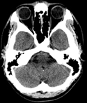 Computed Tomography (CT)
